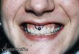 9994 smiley piercing_piercing rtu