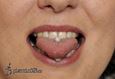 9970 tongue piercing_piercing jazyka