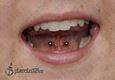 9972 tongue web piercing_piercing jazyka