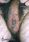 9992 scrotal piercing_intim piercing