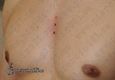 9890 microdermal