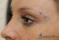 9928 microdermal