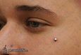 9936 microdermal