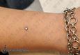 9958 microdermal