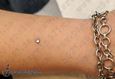 9958 microdermal