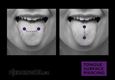 (31) tongue surface piercing
